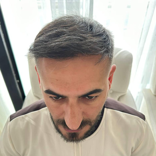 NACHHER